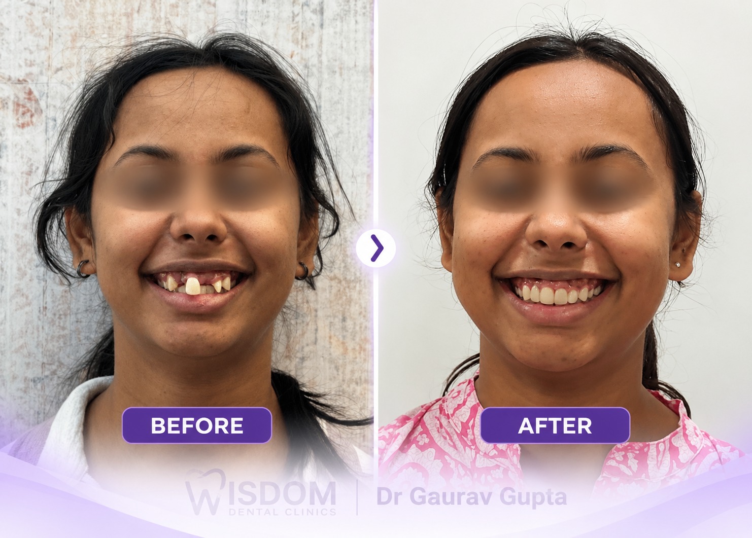 Before and After Smile Transformation 1